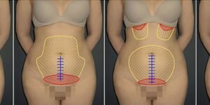o que é abdominoplastia