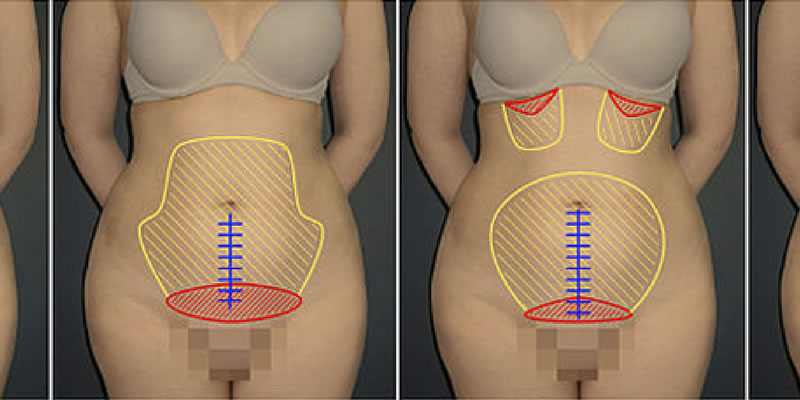 Cirurgia de abdominoplastia: o que impede de fazer?