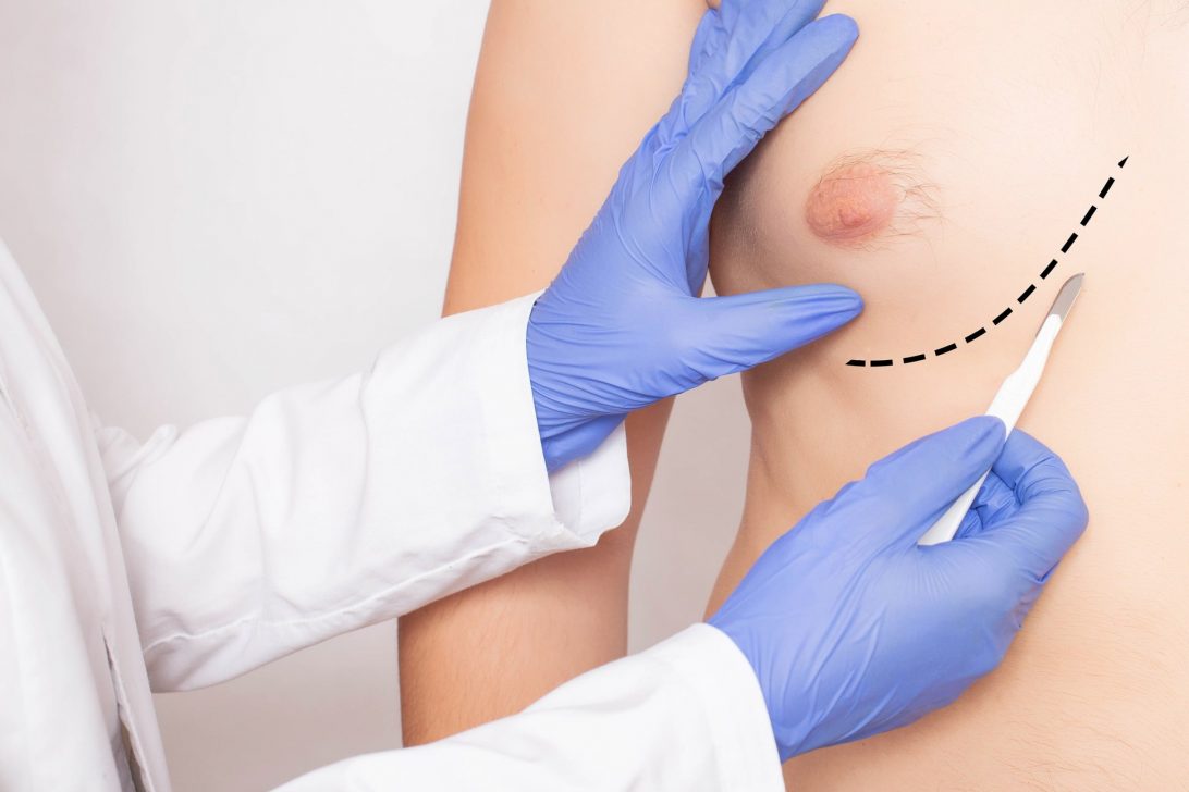 Foto do artigo Ginecomastia: conheça a cirurgia que trata o aumento de mama masculina