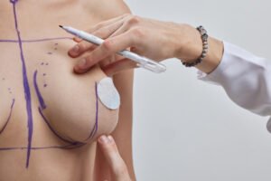 Médico desenhando linhas com a mão sobre o conceito de cirurgia de Mastopexia sem prótese